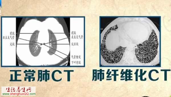 肺纤维化CT图