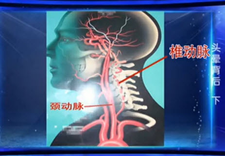 颈动脉狭窄