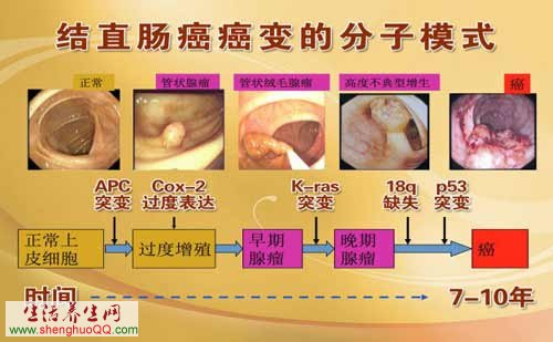 息肉癌变的不同阶段