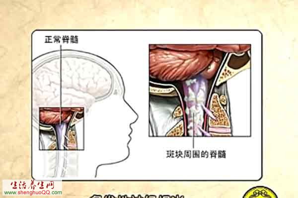 格林巴利综合征