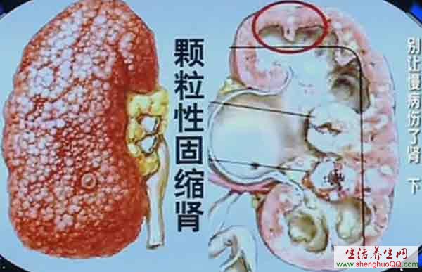 颗粒性固缩肾