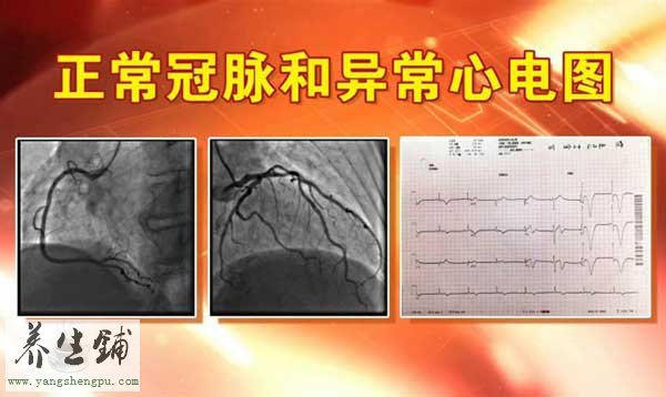 正常冠脉和异常心电图