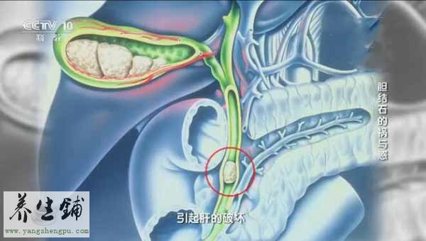 胆结石堵塞在胆总管里