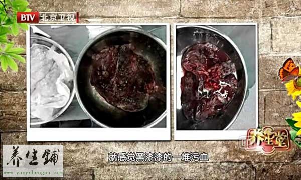 肺部纤维化