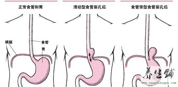 食道裂孔疝