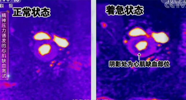 A型性格引起的心肌缺血