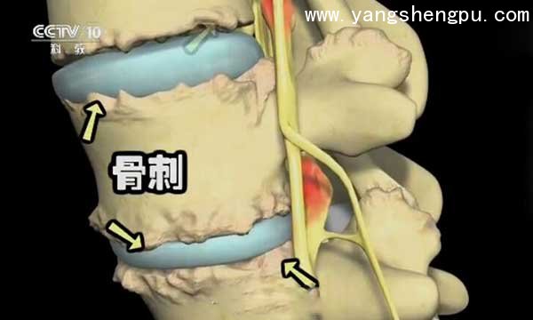 产生骨刺