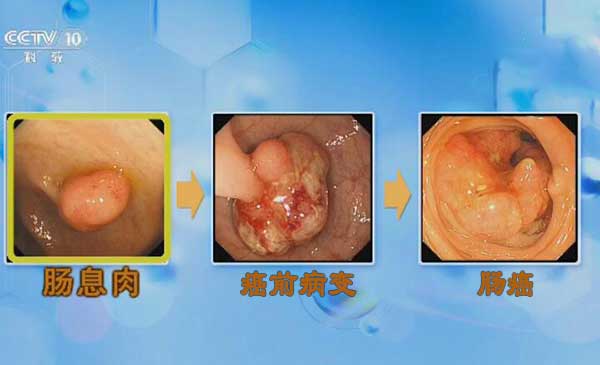 肠癌的发展过程