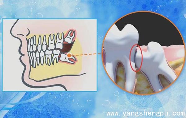 智齿与前面的磨牙存在缝隙
