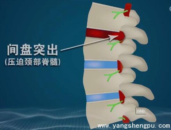 颈椎间盘突出压迫颈部脊髓