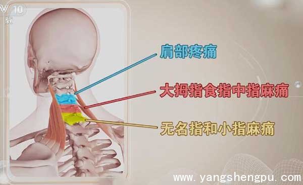 颈椎病判断