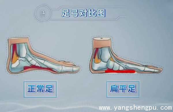 正常足与扁平足