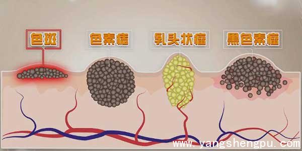 黑色素瘤