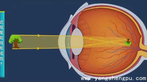 眼轴拉长，焦点落在视网膜前