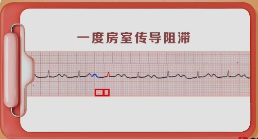 一度房室传导阻滞