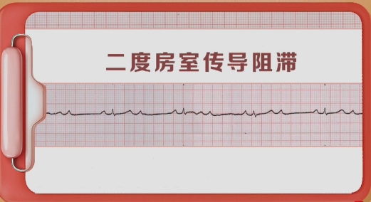 二度房室传导阻滞