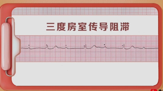 三度房室传导阻滞